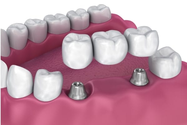 Ilustración de un puente dental de tres piezas que se coloca sobre dos pilares de implante entre dientes naturales