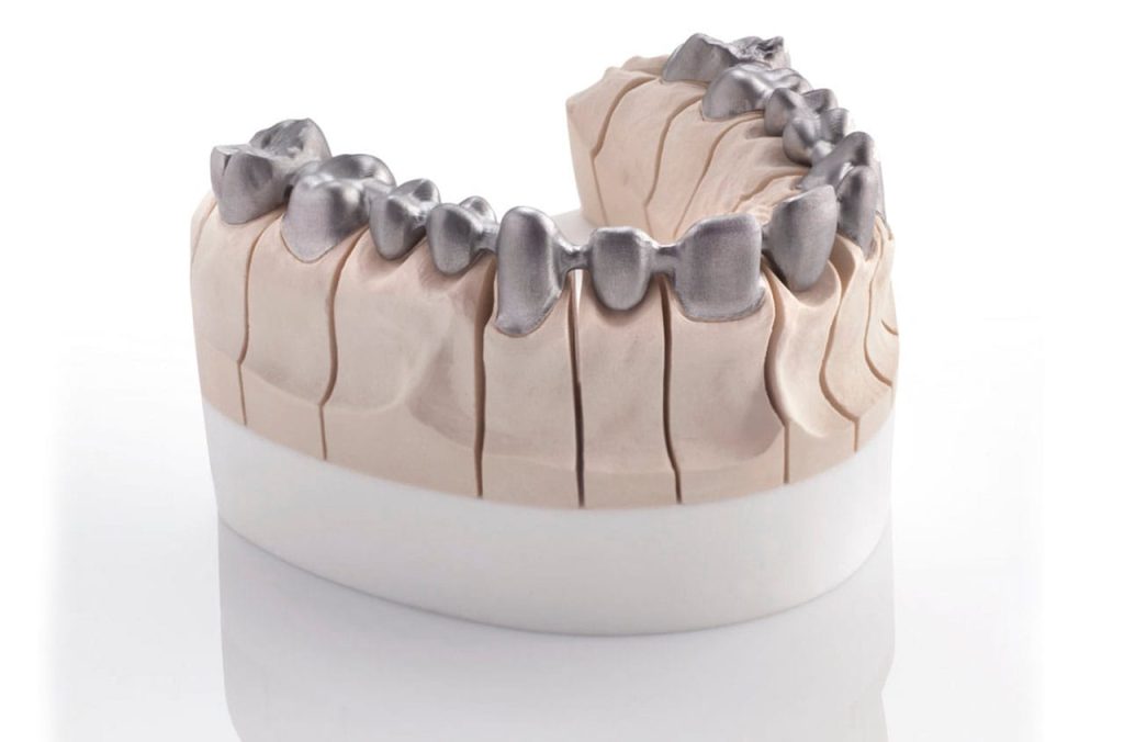 Dientes fijos sin tornillos: opciones, materiales y de qué depende el precio