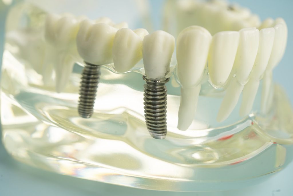 Modelo transparente de mandíbula con un puente de dientes fijo sobre dos implantes